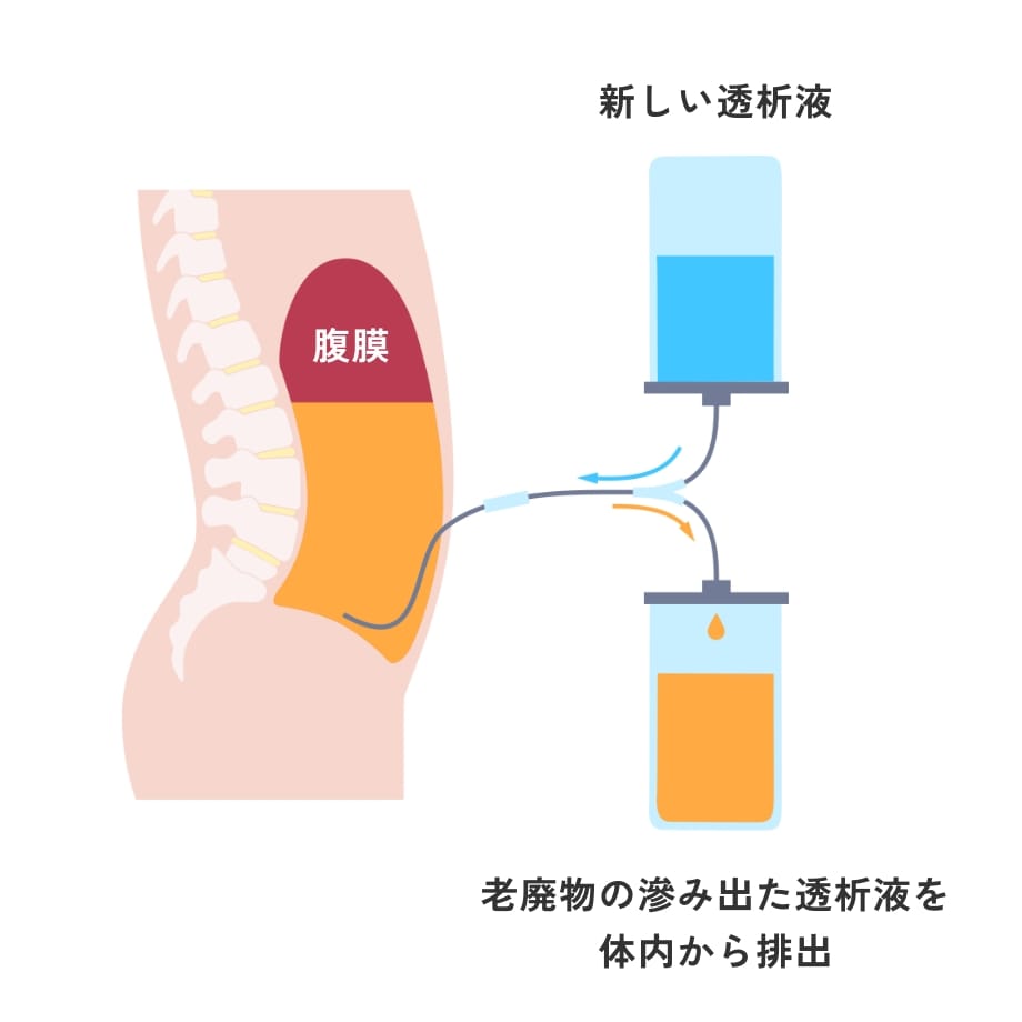 腹膜透析の仕組み:新しい透析液を体内に注入し、老廃物が滲み出た透析液を体外へ排出するイメージ図